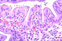 yx21.acute cholecystitis.jpg (9001 bytes)